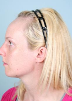Before Hair Transplant&nbsp;Hairline